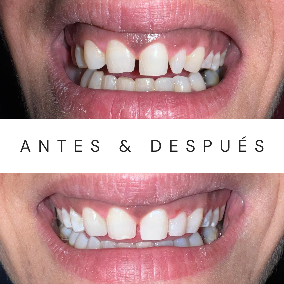 antes & después